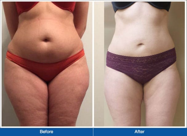 Lipo For Women Before & After NYC
