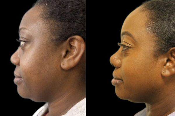 female-rhinoplasty-nyc-2 A woman stands in profile showing the before and after results of her female rhinoplasty in NYC.