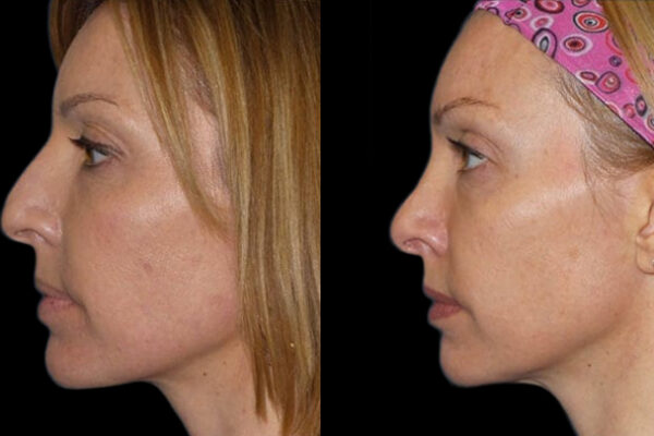 female-rhinoplasty-nyc-before-after-1 A woman in profile showing the before and after results of her female rhinoplasty in NYC.