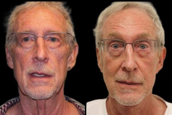 The before and after results of a neck lift in NYC on a male patient.