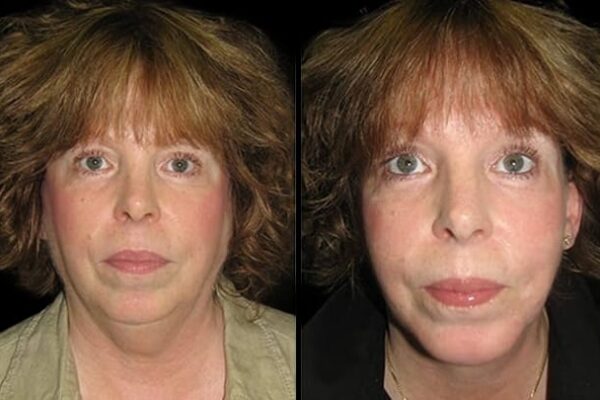 The neck lift results of a female patient in NYC.