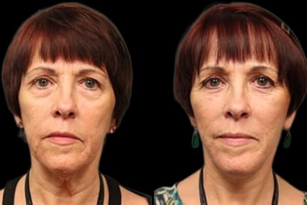 A woman's before and after results of her neck lift in NYC.